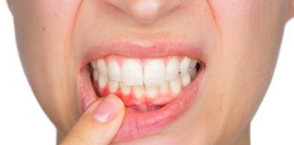 ¿Se pueden perder dientes sanos por culpa de la periodontitis?